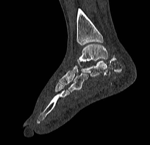 Calcaneal fracture - Sanders type 4 (Radiopaedia 90179-107370 Sagittal bone window 51).jpg