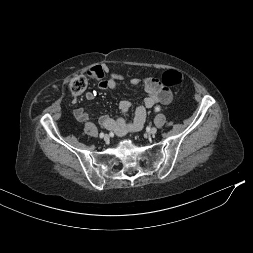 Calcified adrenal glands and Spigelian hernia (Radiopaedia 49741-54988 A 173).jpg