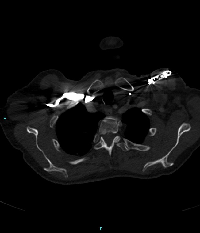Calcified cerebral emboli from left ventricular thrombus (Radiopaedia 84420-99760 Axial bone window 9).jpg