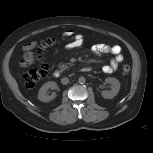 File:Calcified hepatic hydatid cyst (Radiopaedia 18907-18853 Axial non-contrast 29).jpg