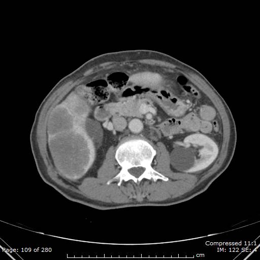 Calcified liver metastases (Radiopaedia 44699-48470 B 39).jpg