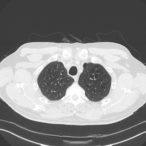 Caplan syndrome (Radiopaedia 56667-63530 Axial lung window 40).jpg