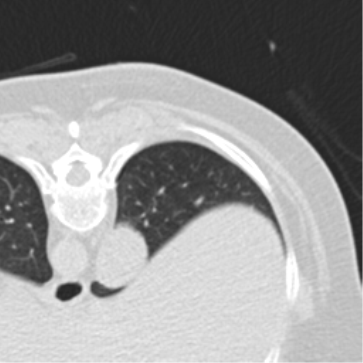 File:Carcinoid tumor - lung (Radiopaedia 44814-48644 Axial lung window 87).png