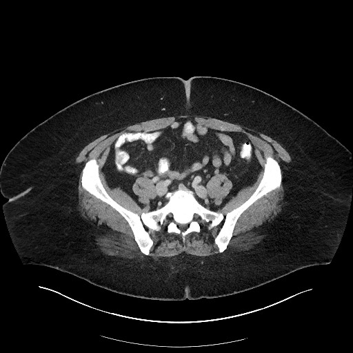 Carcinoid tumor - terminal ileum (Radiopaedia 60931-68739 A 94).jpg