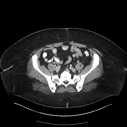 Carcinoid tumor - terminal ileum (Radiopaedia 60931-68739 A 97).jpg