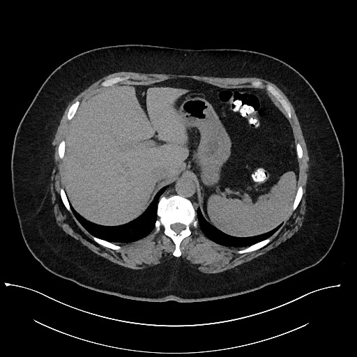 Carcinoid tumor - terminal ileum (Radiopaedia 60931-68740 Axial non-contrast 17).jpg