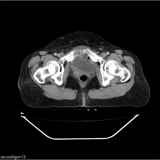 Carcinoma cervix- recurrence (Radiopaedia 34702-36137 B 51).jpg