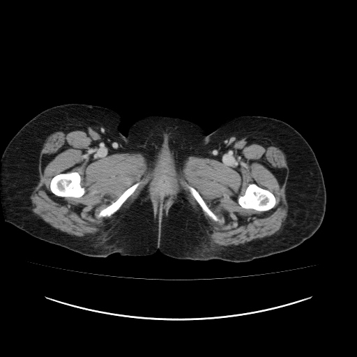 Carcinoma colon - hepatic flexure (Radiopaedia 19461-19493 A 139).jpg