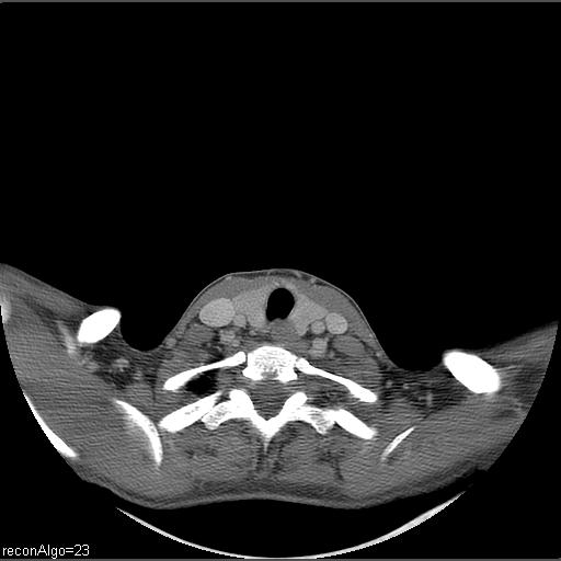 Carcinoma of the maxillary antrum (Radiopaedia 53805-59888 Axial C+ delayed 4).jpg