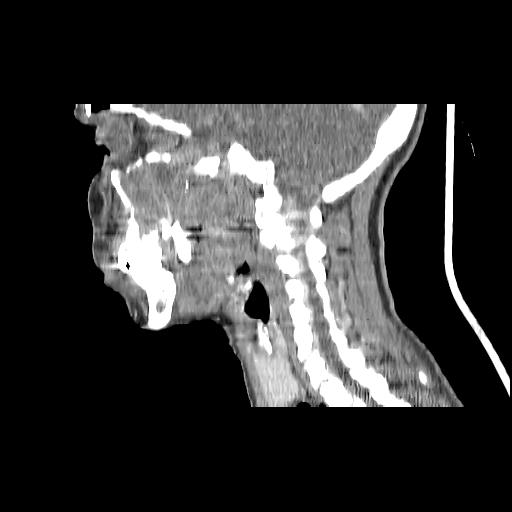 Carcinoma of the maxillary antrum (Radiopaedia 53805-59888 Sagittal C+ delayed 78).jpg