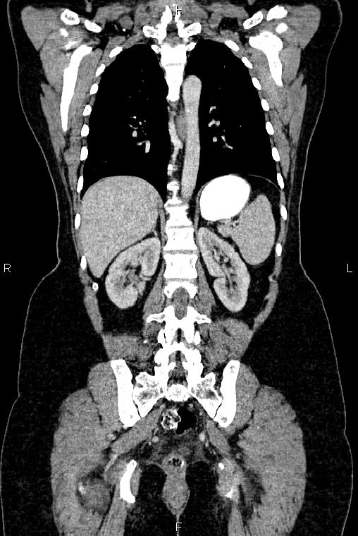 Carcinoma of uterine cervix (Radiopaedia 85861-101700 C 40).jpg