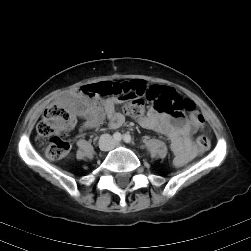 Carcinosarcoma (Radiopaedia 70401-80503 A 40).jpg