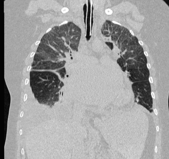 Cardiogenic pulmonary edema (Radiopaedia 29213-29609 Coronal lung window 32).jpg