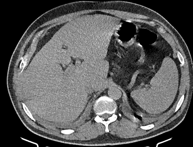 Cardiogenic pulmonary edema (Radiopaedia 68180-77678 Axial non-contrast 59).jpg