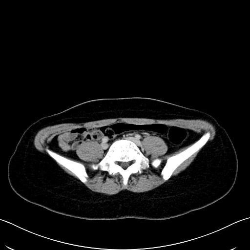 Caroli disease with medullary sponge kidney (Radiopaedia 82622-96804 C 51).jpg