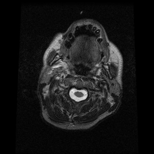 File:Carotid arterial dissection (Radiopaedia 30001-30547 Axial T2 1).jpg