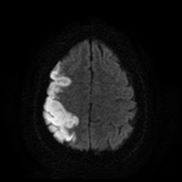 File:Carotid arterial dissection with acute cerebral infarction (Radiopaedia 26636-26784 Axial DWI 17).jpg