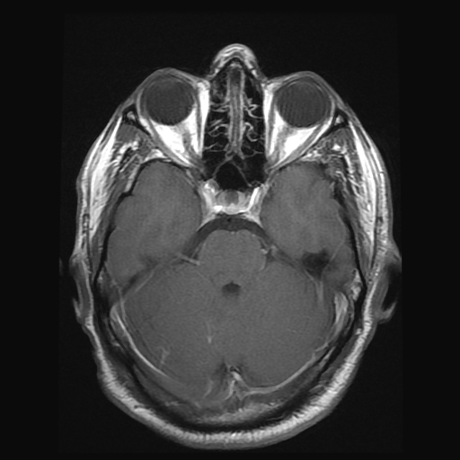 File:Carotid arterial dissection with acute cerebral infarction (Radiopaedia 26636-26784 Axial T1 C+ 7).jpg