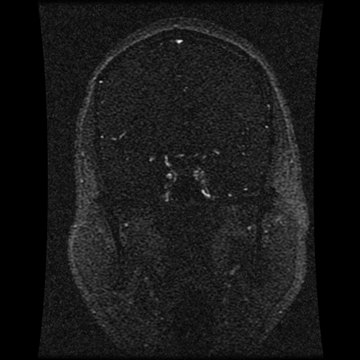 Carotid arterial dissection with acute cerebral infarction (Radiopaedia 26636-26784 MRV 106).jpg