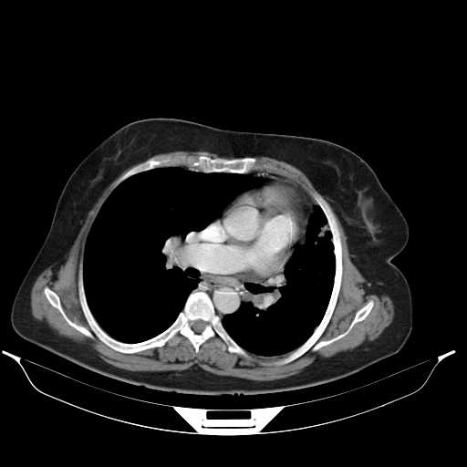 File:Carotid body tumor (Radiopaedia 21021-20948 A 37).jpg