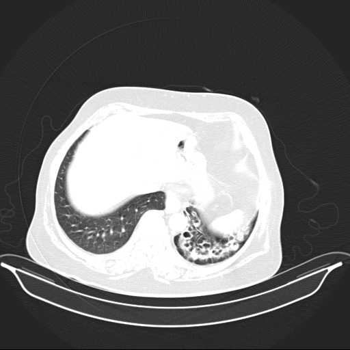 File:Carotid body tumor (Radiopaedia 21021-20948 Axial lung window 37).jpg