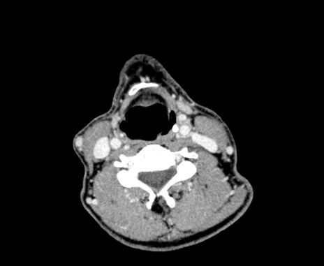 Carotid body tumor (Radiopaedia 61750-69757 Axial Post contrast 65).jpg
