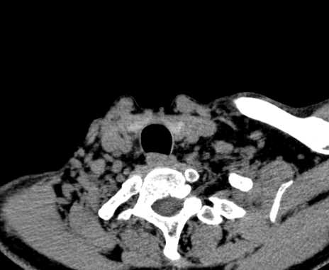 File:Carotid body tumor (Radiopaedia 61750-69757 Axial non-contrast 102).jpg