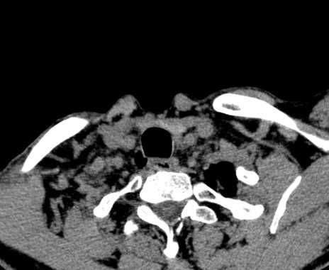 File:Carotid body tumor (Radiopaedia 61750-69757 Axial non-contrast 106).jpg