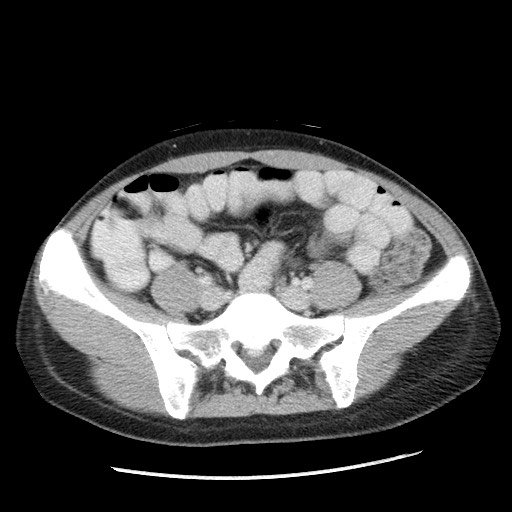 Castleman disease with fibrous pseudotumor in the abdomen (Radiopaedia 77296-89373 A 88).jpg