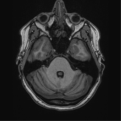Cavernoma with bleed - midbrain (Radiopaedia 54546-60774 Axial T1 4).png