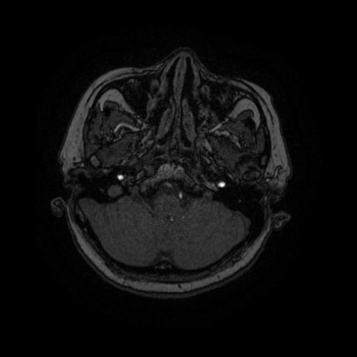 Cavernoma with developmental venous anomaly (Radiopaedia 22470-22507 MRA 82).jpg