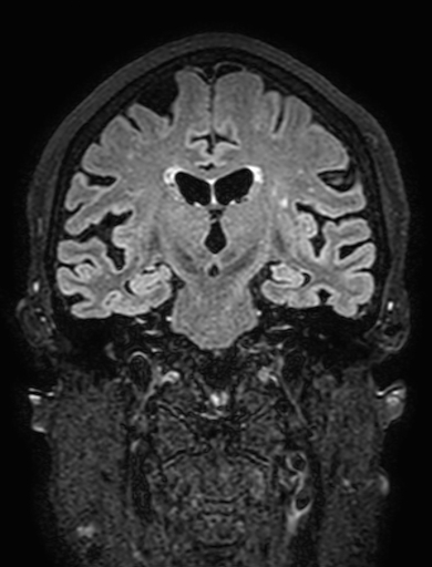 Cavernous hemangioma of the cerebellar falx (Radiopaedia 73025-83724 Coronal FLAIR 181).jpg