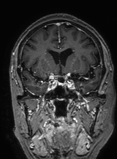 Cavernous hemangioma of the cerebellar falx (Radiopaedia 73025-83724 Coronal T1 C+ 145).jpg