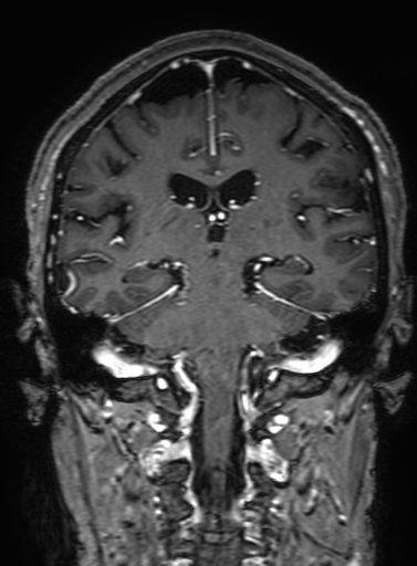 Cavernous hemangioma of the cerebellar falx (Radiopaedia 73025-83724 Coronal T1 C+ 224).jpg