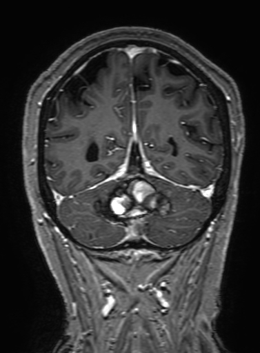 Cavernous hemangioma of the cerebellar falx (Radiopaedia 73025-83724 Coronal T1 C+ 289).jpg