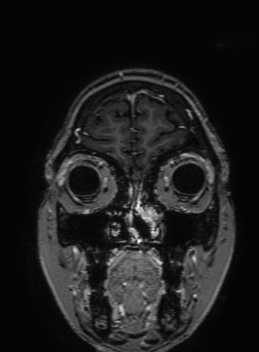 Cavernous hemangioma of the cerebellar falx (Radiopaedia 73025-83724 Coronal T1 C+ 51).jpg