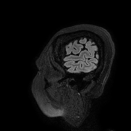 File:Cavernous hemangioma of the cerebellar falx (Radiopaedia 73025-83724 Sagittal FLAIR 206).jpg