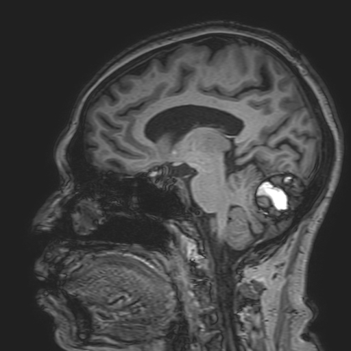 File:Cavernous hemangioma of the cerebellar falx (Radiopaedia 73025-83724 Sagittal T1 95).jpg