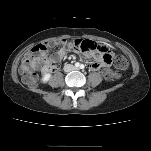 File:Cavernous hepatic hemangioma (Radiopaedia 75441-86667 B 68).jpg