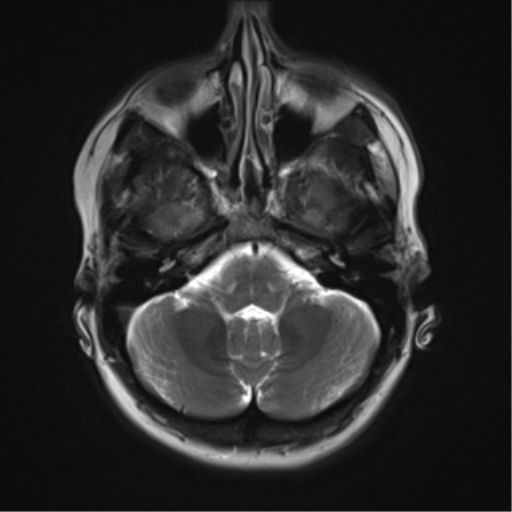 File:Cavernous malformation (cavernous angioma or cavernoma) (Radiopaedia 36675-38237 Axial T2 4).png