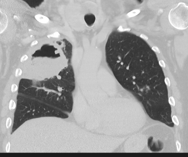 Cavitating pneumonia (Radiopaedia 45998-50329 Coronal lung window 20).png