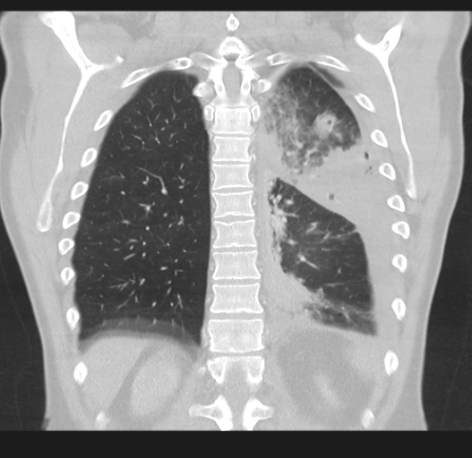 Cavitating pneumonia complicated by pneumothorax (Radiopaedia 48149-52994 Coronal lung window 44).png