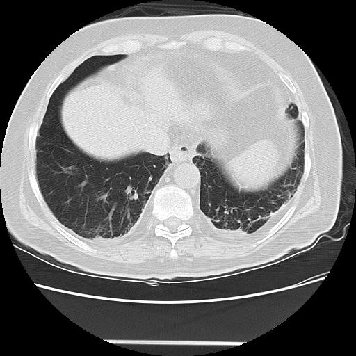 Cavitating pulmonary metastases (Radiopaedia 89545-106544 Axial lung window 44).jpg