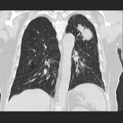 File:Cavitating pulmonary metastases (Radiopaedia 89545-106544 Coronal lung window 28).jpg