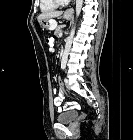 Cecal adenocarcinoma (Radiopaedia 85324-100916 E 52).jpg