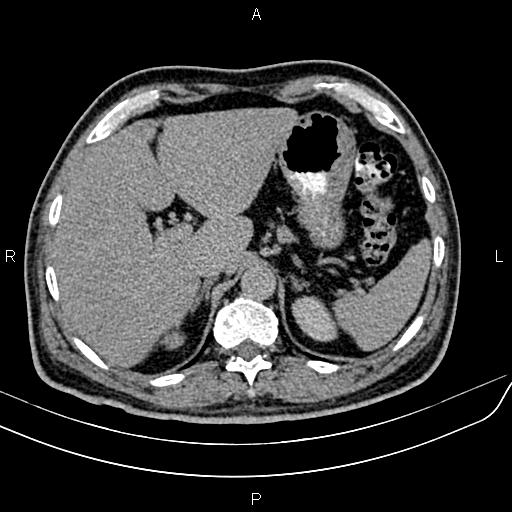 File:Cecal cancer with appendiceal mucocele (Radiopaedia 91080-108651 Axial C+ delayed 5).jpg