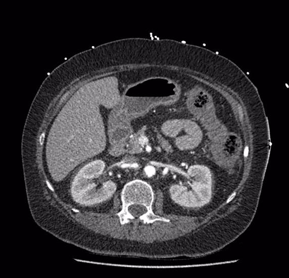 Celiac artery severe stenosis and dissection (Radiopaedia 44128-47842 B 33).jpg