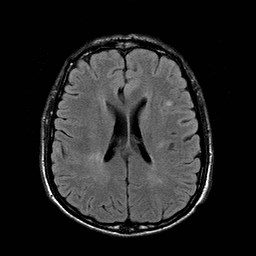 File:Central-variant posterior reversible encephalopathy syndrome (PRES) (Radiopaedia 43880-47358 Axial FLAIR 15).jpg
