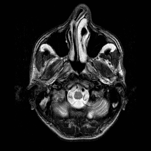 File:Central-variant posterior reversible encephalopathy syndrome (PRES) (Radiopaedia 43880-47359 Axial T2 1).jpg