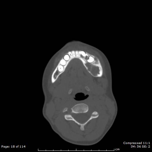 File:Central giant cell granuloma (Radiopaedia 45612-49754 Axial bone window 9).jpg